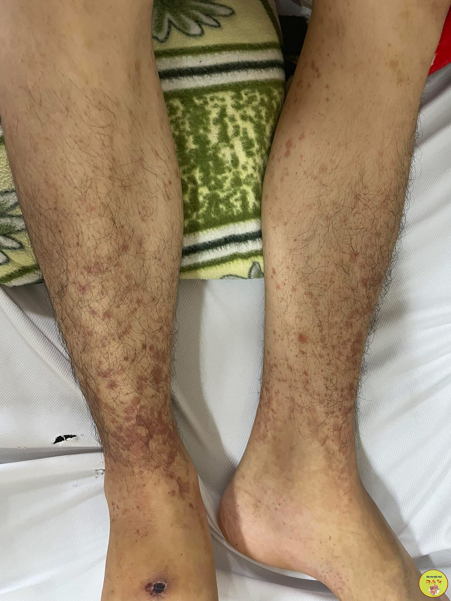 CA LÂM SÀNG SỐT XUẤT HUYẾT